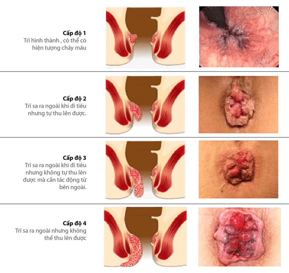 Trĩ - căn bệnh gây khó chịu cho người bệnh