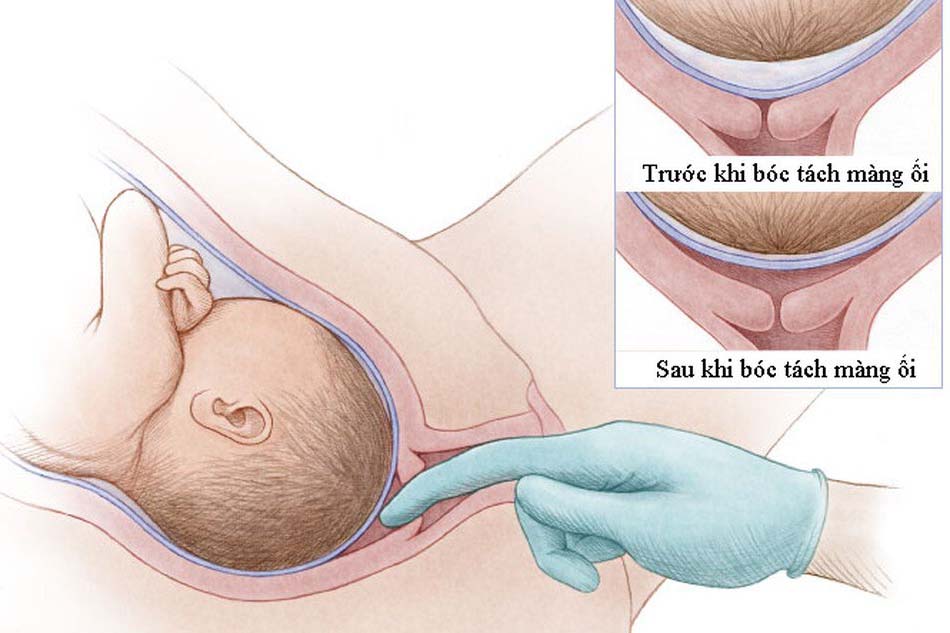 Thời điểm khởi phát chuyển dạ tối ưu sau ối vỡ non ở thai đủ thángThời điểm khởi phát chuyển dạ tối ưu sau ối vỡ non ở thai đủ tháng