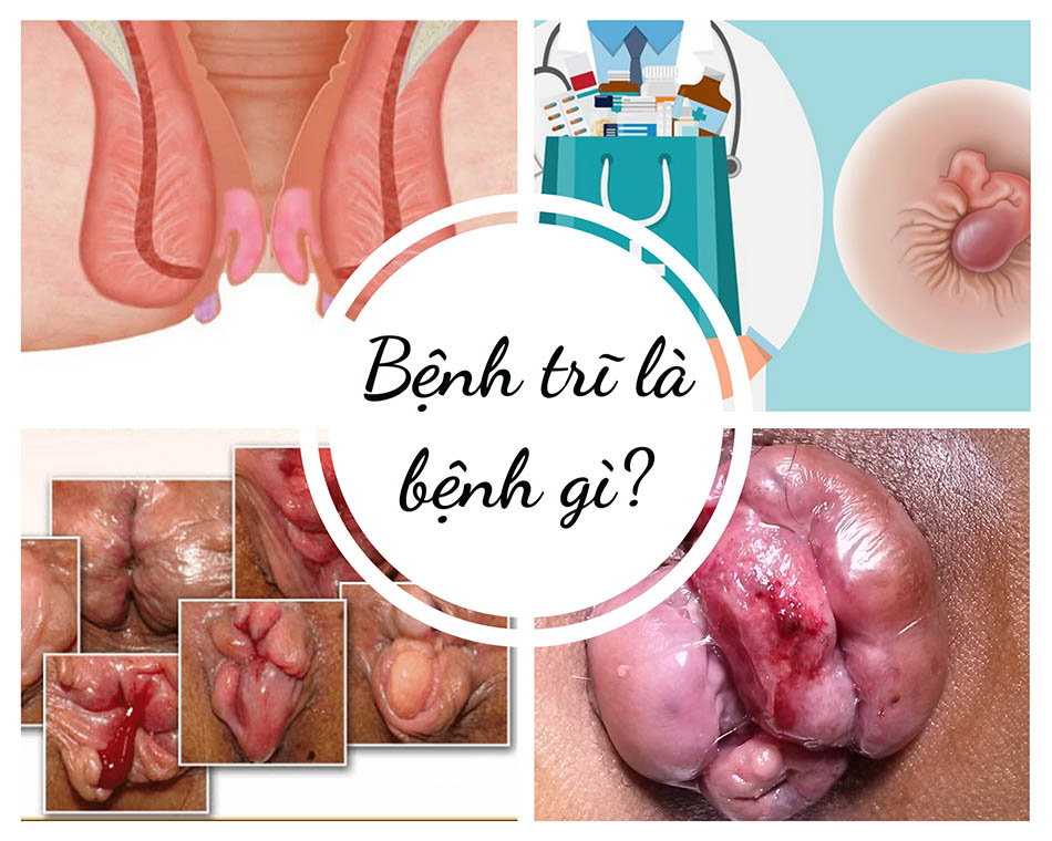 Bệnh trĩ là bệnh gì?