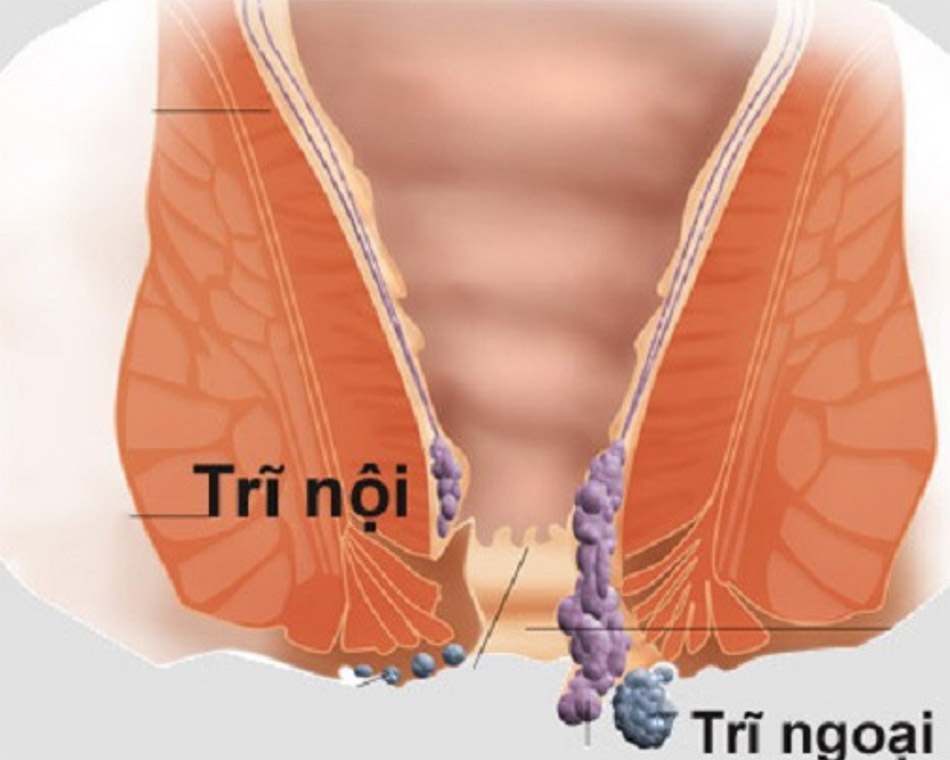 Trĩ nội và trĩ ngoại