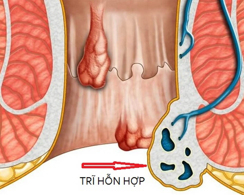 Trĩ hỗn hợp