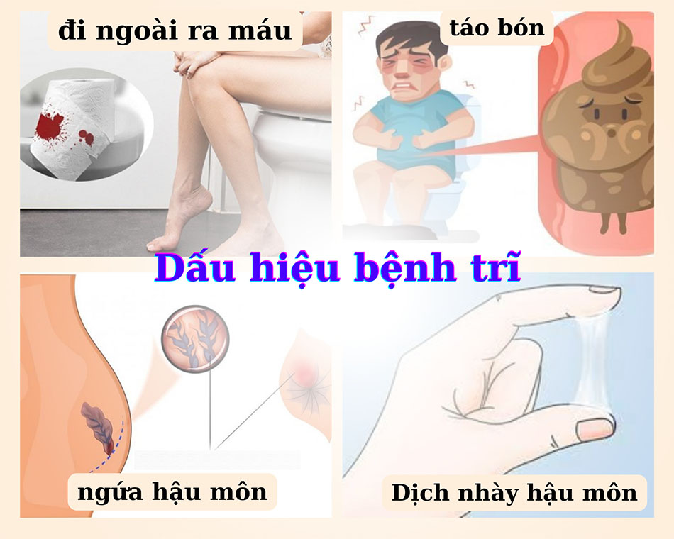 Dấu hiệu của bệnh trĩ