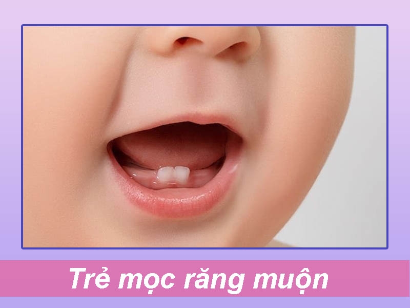 Trẻ mọc răng muộn